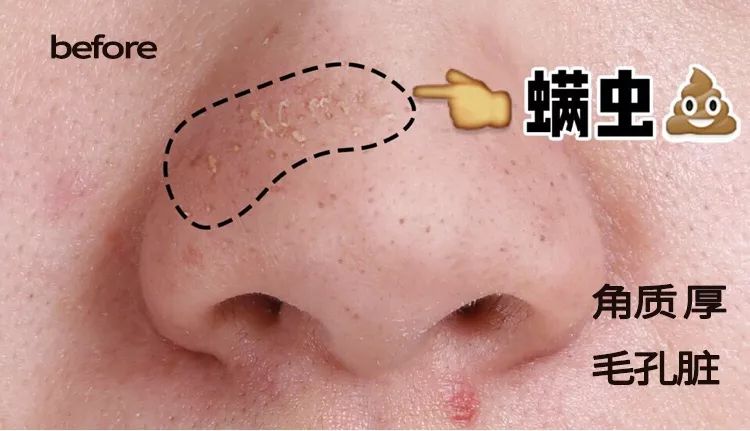 脸上搓下来很多泥,脸上搓出黑头