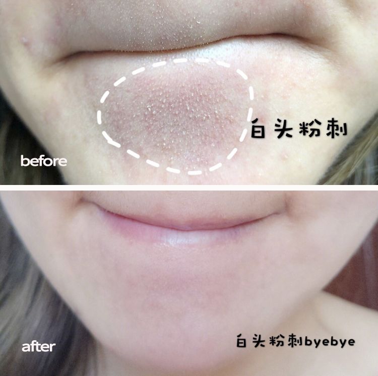 脸上搓下来很多泥,脸上搓出黑头