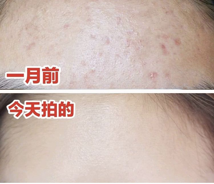 脸上搓下来很多泥,脸上搓出黑头