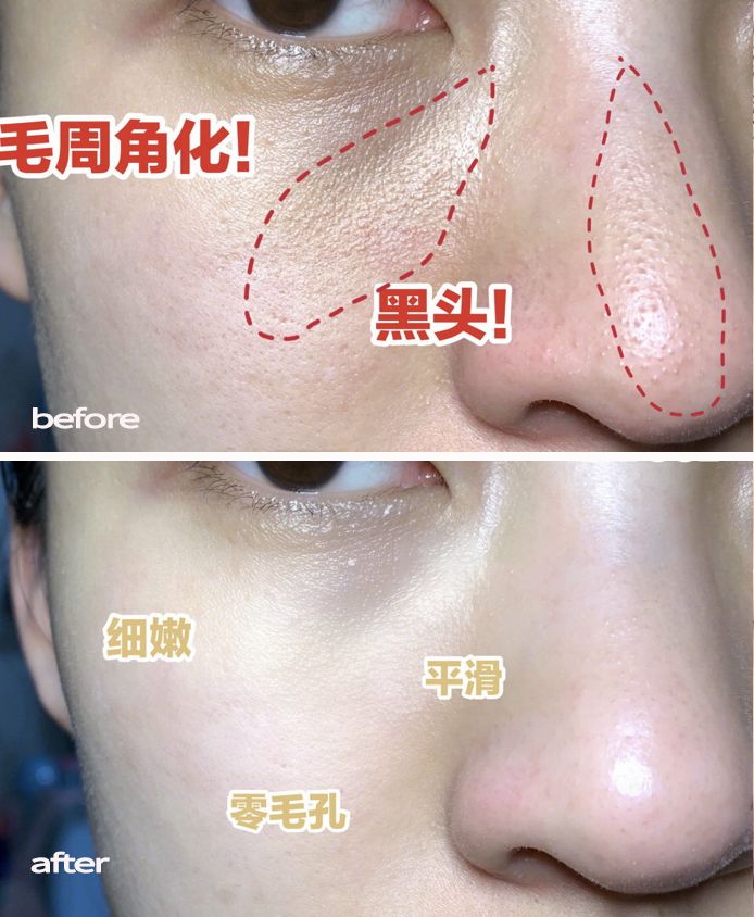 脸上搓下来很多泥,脸上搓出黑头