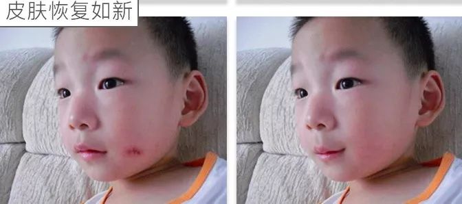 比创可贴好用,最好用的液体创可贴