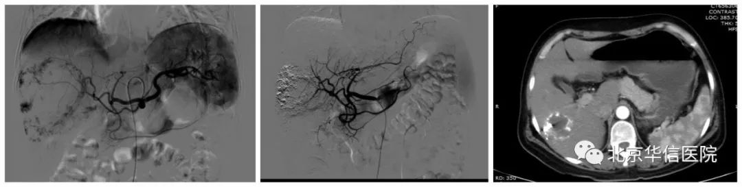微创治疗巨大肝血管瘤新突破,微创手术做肝上的血管瘤的全过程