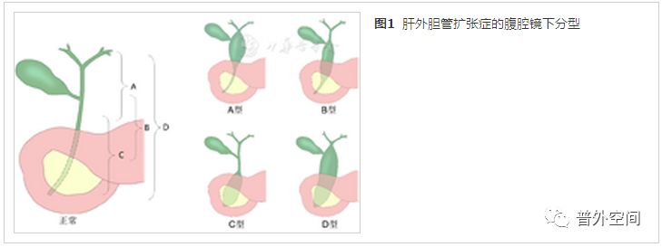 肝内外胆管扩张并梗阻病例,先天性肝内胆管囊性扩张分型