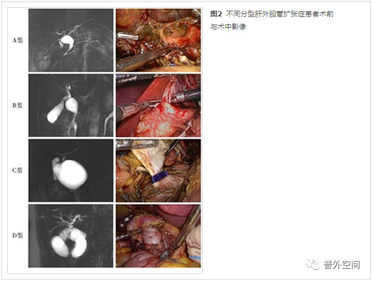 肝内外胆管扩张并梗阻病例,先天性肝内胆管囊性扩张分型