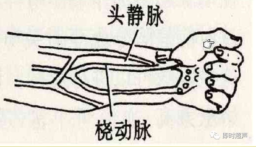 血液透析动静脉造瘘的超声评价