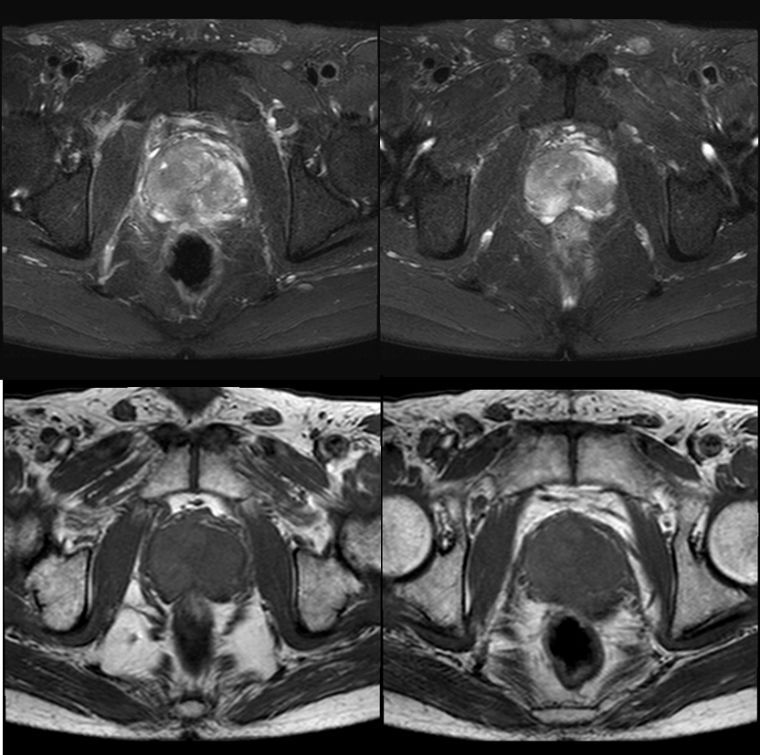 转移性内分泌治疗敏感性前列腺癌,抵抗性转移性前列腺癌