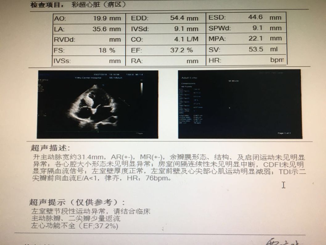 心梗后心衰如何管理？新型心衰药物带来全新突破