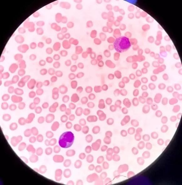 外周血细胞形态分析能查出什么病,外周血细胞形态能看出白血病吗