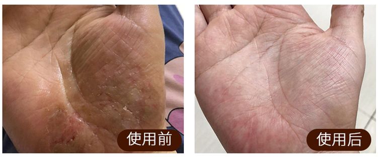 足癣药膏一天涂几次较好,湿疹性皮炎涂了一次药没效果