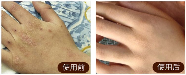 足癣药膏一天涂几次较好,湿疹性皮炎涂了一次药没效果