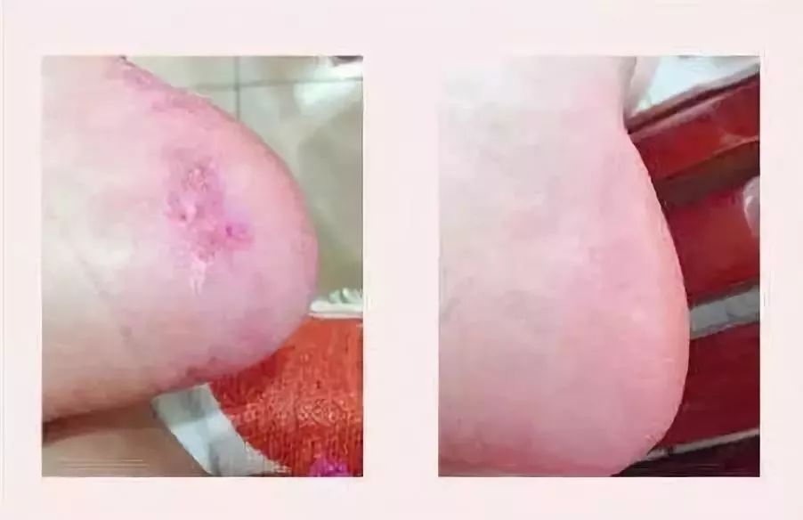 足癣药膏一天涂几次较好,湿疹性皮炎涂了一次药没效果