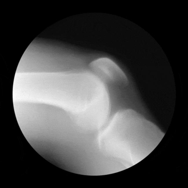 膝盖哪种病疼的最厉害,膝盖有一万种疼法骨科专家教你