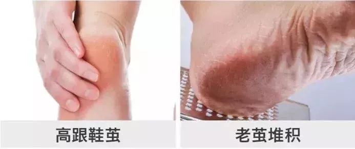 治脚气的抗真菌偏方,角化型脚气干裂最好的药