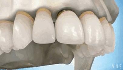 种牙医保补贴政策,牙享补贴最新消息