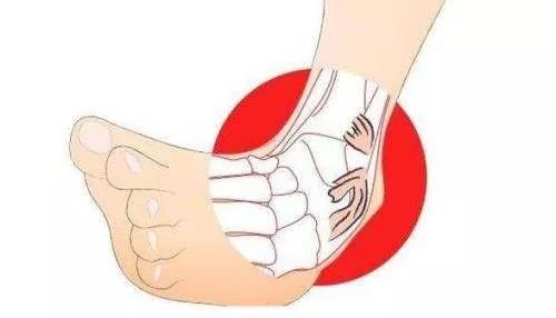 冰敷热敷崴脚,冰敷崴脚后更疼了