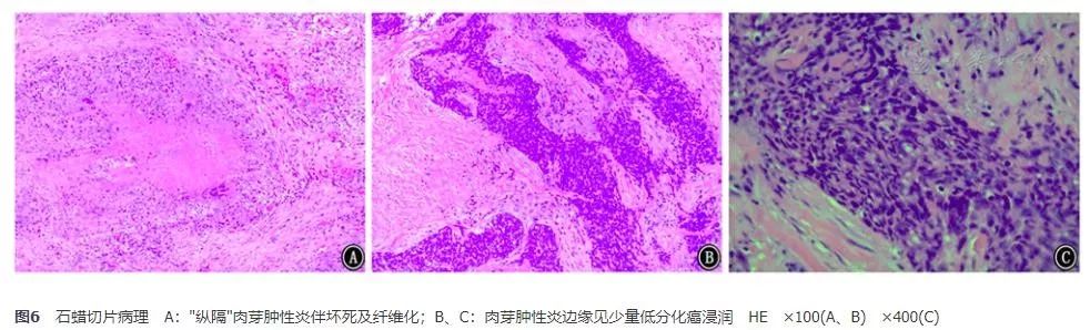 胸腺鳞癌一例并文献复习