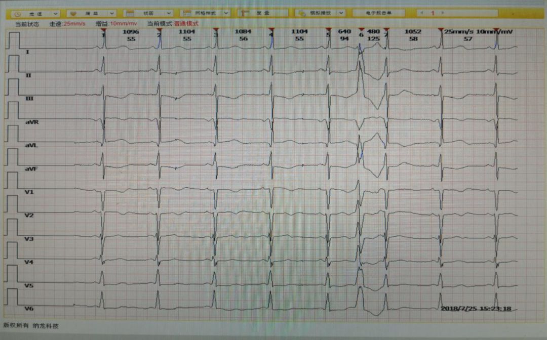缺血性心脏病吃哪些中成药,心肌缺血合并心衰吃什么恢复得快