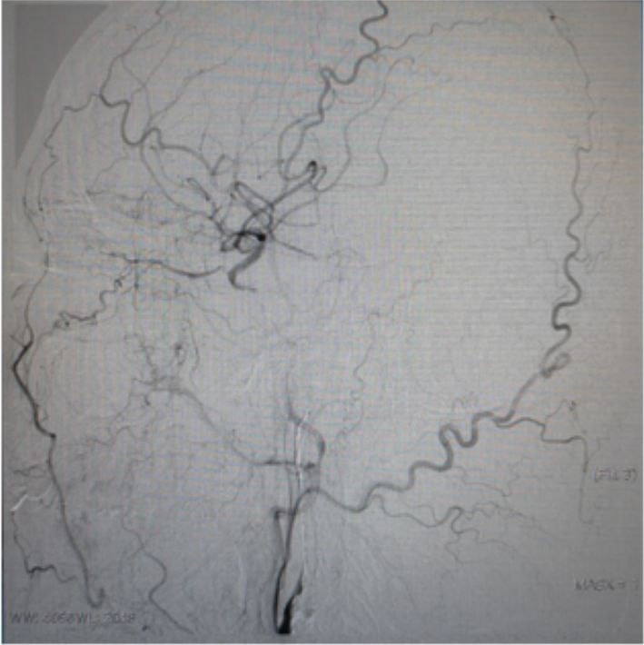 颈内动脉闭塞先进治疗,颈内动脉闭塞开通术病例讨论