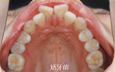 牙齿矫正新措施落地福州,福州牙齿矫正免费领取