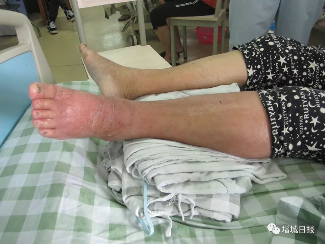 被红火蚁咬伤新闻,被一只红火蚁咬伤后的处理