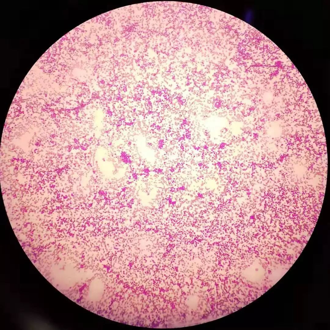 全血细胞减少就是白血病,全血细胞减少性白血病