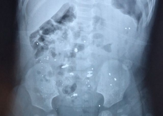 怀疑孩子误食水银了该怎么办,小孩误食水银会怎么办