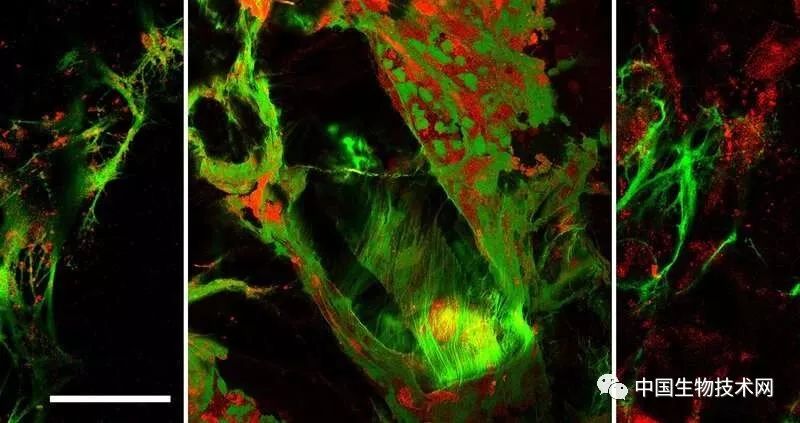 1.2大的胆结石是多长时间形成的,如何发现胆结石