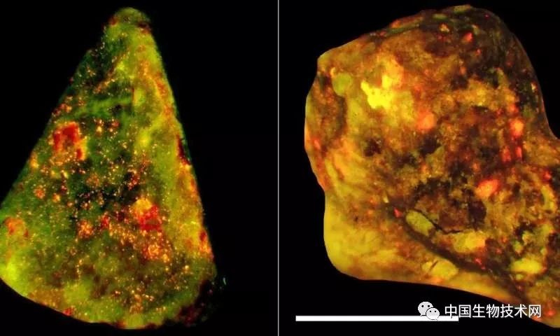 1.2大的胆结石是多长时间形成的,如何发现胆结石