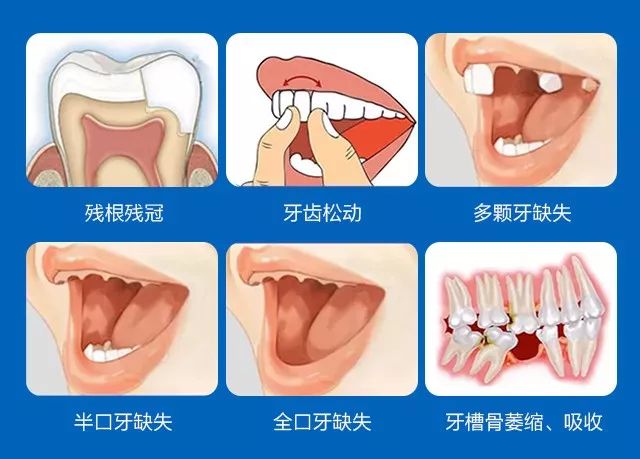2023年天津种牙能纳入医保吗,天津人有没有什么优惠政策