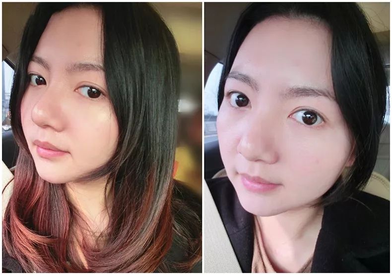 鼻头痘痘爆浆,鼻头痘痘挤出来的白色物质是什么