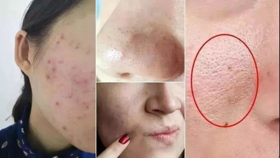 鼻头痘痘爆浆,鼻头痘痘挤出来的白色物质是什么