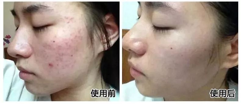 鼻头痘痘爆浆,鼻头痘痘挤出来的白色物质是什么