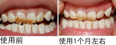 不用打磨牙齿的快速美白方法,不用洗牙能把牙垢黄牙变白的方法