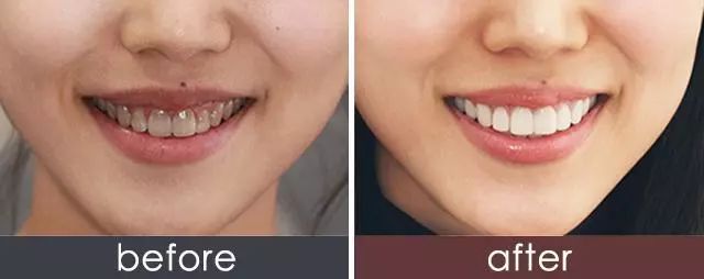 不用打磨牙齿的快速美白方法,不用洗牙能把牙垢黄牙变白的方法