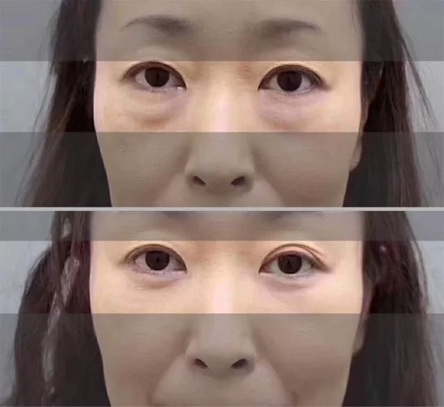 眼袋松弛下垂最快解决方法,严重眼袋下垂松弛怎么恢复