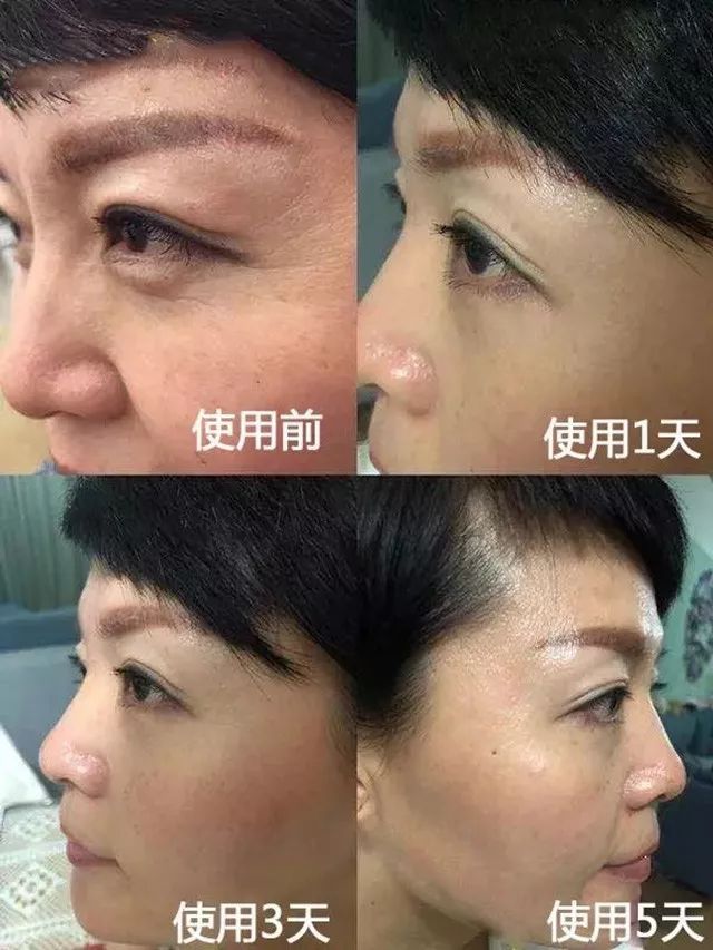 眼袋松弛下垂最快解决方法,严重眼袋下垂松弛怎么恢复