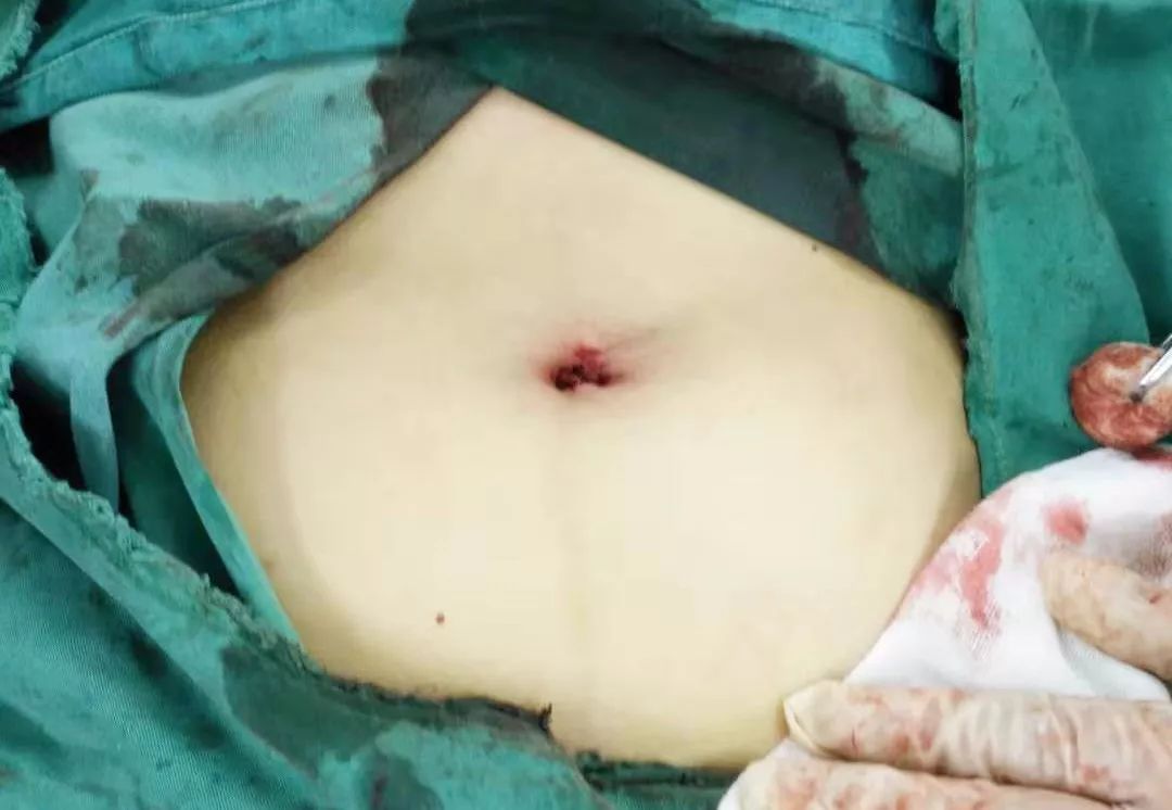 男士乳房单孔腹腔镜微创手术,腹腔镜微型手术