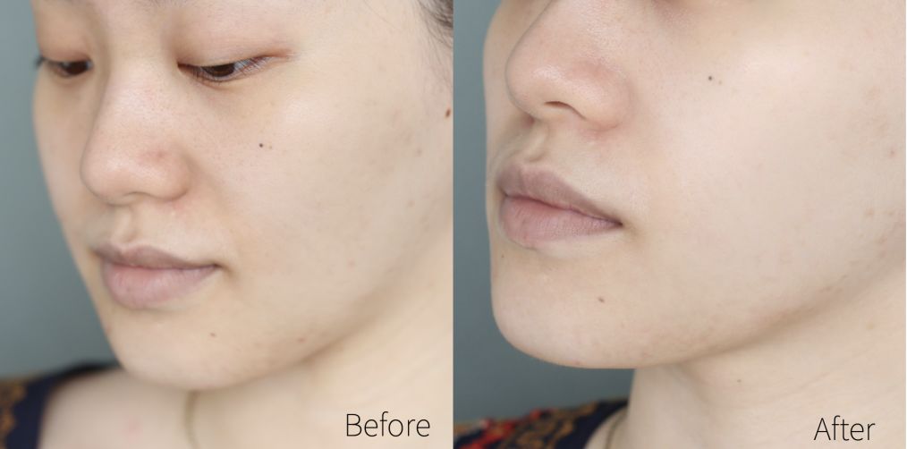 蒂佳婷哪款面膜适合晒后使用,drjart蒂佳婷紫色面膜使用方法