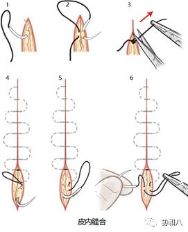 临行密密缝——不同缝合方法特点和适用条件（下）|朝花夕拾·协和八