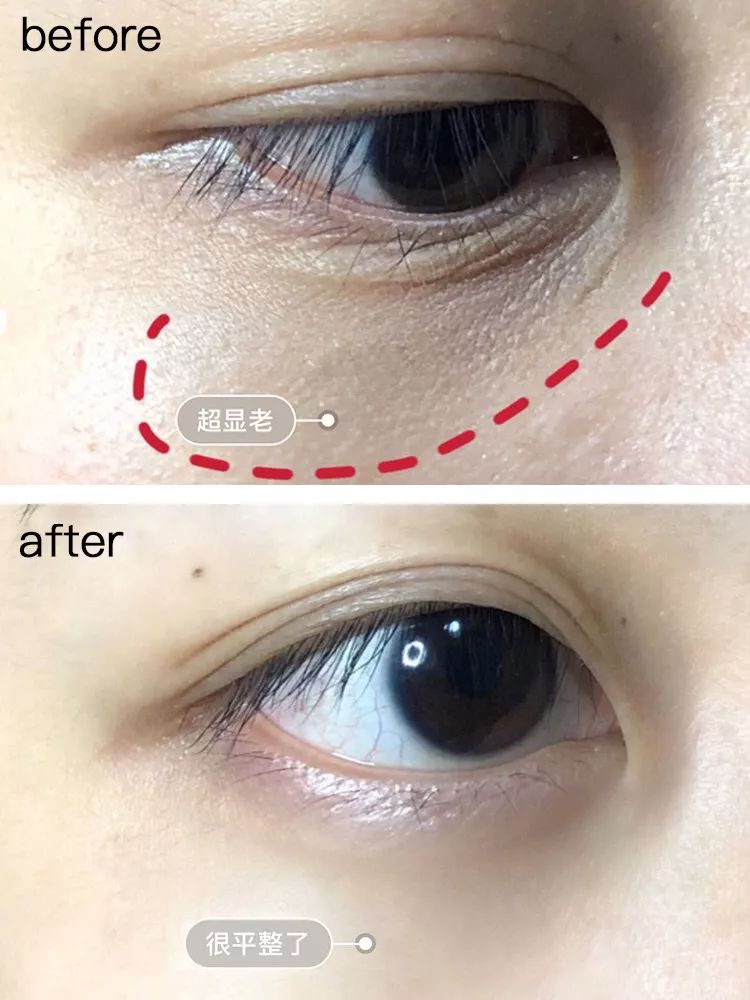 在美国治疗痔疮经历,在美国最好卖的痔疮药