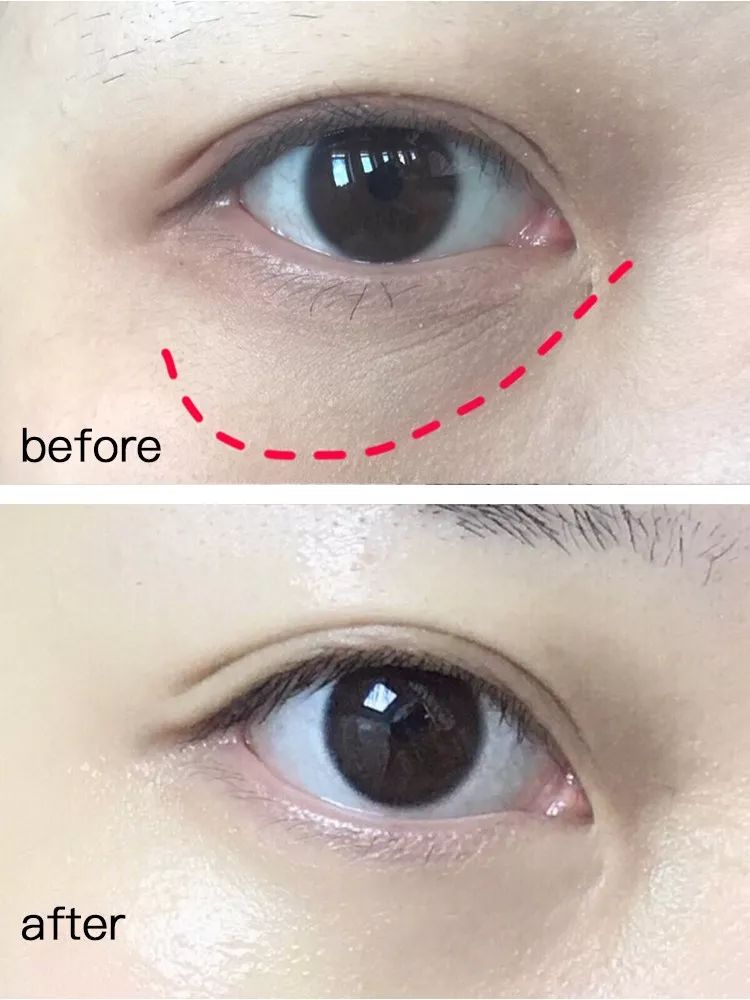 在美国治疗痔疮经历,在美国最好卖的痔疮药