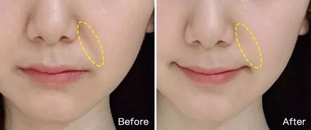 在美国治疗痔疮经历,在美国最好卖的痔疮药