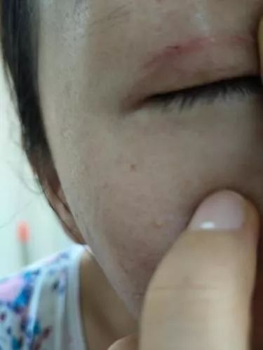 女子整容失败后欲哭无泪,女子整容整到脸上神经错乱
