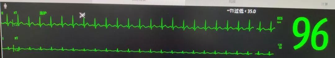 icu病房怎么监护,icu床边ct有影响吗