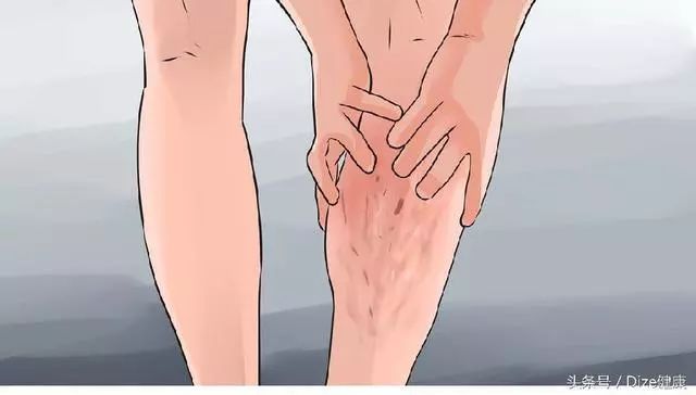 静脉曲张怎么保护好腿,夏季静脉曲张护腿