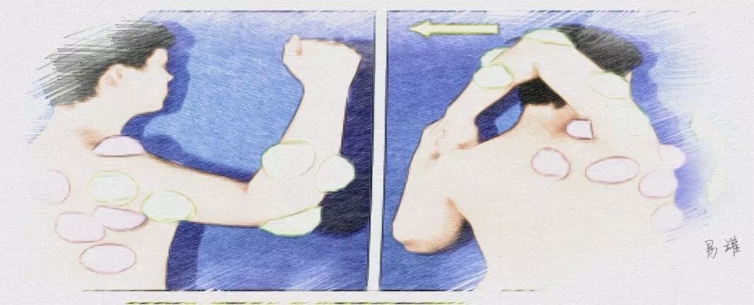 拔罐可以搞定哪些小毛病,拔罐疗法的适应症和作用