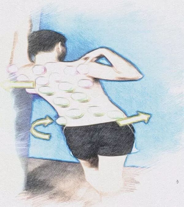 拔罐可以搞定哪些小毛病,拔罐疗法的适应症和作用