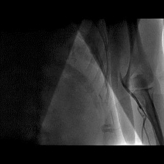 冠脉造影技术成熟不,跟我学技术分析从入门到精通