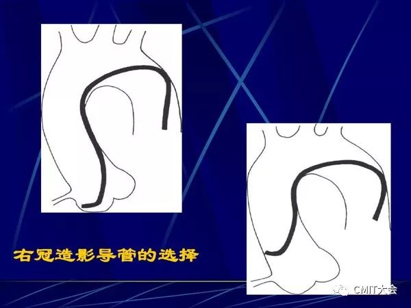 冠脉造影技术成熟不,跟我学技术分析从入门到精通