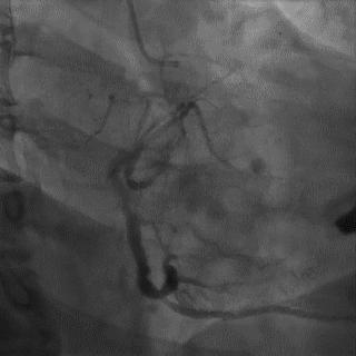 冠脉造影技术成熟不,跟我学技术分析从入门到精通
